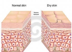 dry-Normal-skin