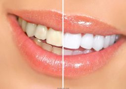 راه های خانگی برای سفید کردن دندان‌ها